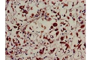 Immunohistochemistry of paraffin-embedded human melanoma using ABIN7174288 at dilution of 1:100 (USP22 anticorps  (C-Term))