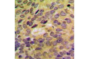 Immunohistochemical analysis of SH3GLB2 staining in human breast cancer formalin fixed paraffin embedded tissue section.