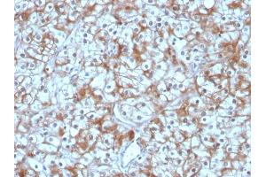 Formalin-fixed, paraffin-embedded human Bladder Carcinoma stained with Calpastatin Mouse Monoclonal Antibody (CAST/1550). (Calpastatin anticorps)