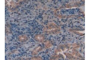 Detection of GLa in Human Thyroid cancer Tissue using Polyclonal Antibody to Galactosidase Alpha (GLa)