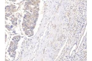 Detection of GPC3 in Human Liver cancer Tissue using Polyclonal Antibody to Glypican 3 (GPC3)