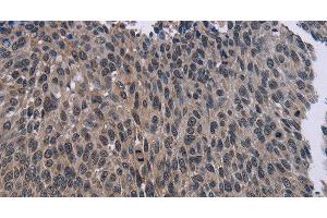 Immunohistochemistry of paraffin-embedded Human lung cancer using KDM4D Polyclonal Antibody at dilution of 1:50 (JMJD2D anticorps)
