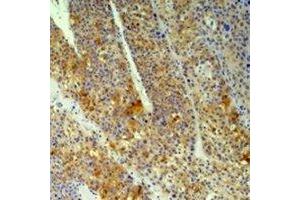 Immunohistochemical analysis of Cyclophilin B staining in human heptacancer,human pancreatic cancer formalin fixed paraffin embedded tissue section. (PPIB anticorps)