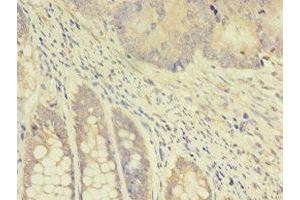 Immunohistochemistry of paraffin-embedded human colon cancer using ABIN7172114 at dilution of 1:100