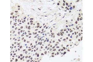 Immunohistochemistry of paraffin-embedded Human lung cancer using RPP30 Polyclonal Antibody at dilution of 1:100 (40x lens). (RPP30 anticorps)