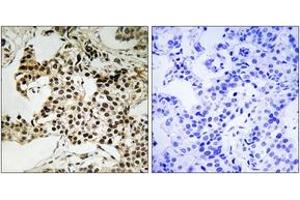 Immunohistochemistry analysis of paraffin-embedded human breast carcinoma, using PKR (Phospho-Thr258) Antibody. (EIF2AK2 anticorps  (pThr258))
