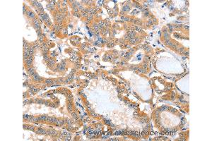Immunohistochemistry of Human thyroid cancer using ACOT11 Polyclonal Antibody at dilution of 1:25