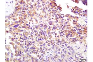 Formalin-fixed and paraffin embedded human bladder carcinoma labeled with Rabbit Anti CD138/Syndecan-1 Polyclonal Antibody, Unconjugated (ABIN674769) at 1:200 followed by conjugation to the secondary antibody and DAB staining (Syndecan 1 anticorps  (AA 201-310))