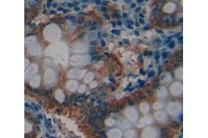 IHC-P analysis of Human Tissue, with DAB staining. (LASP1 anticorps  (AA 1-261))
