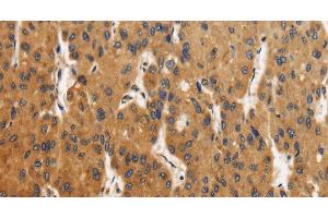 Immunohistochemistry of paraffin-embedded Human liver cancer using CALU Polyclonal Antibody at dilution of 1:40 (CALU anticorps)