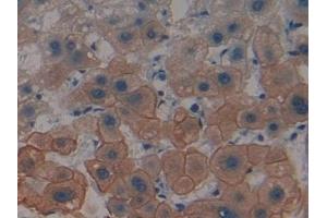 Detection of CK4 in Human Liver cancer Tissue using Polyclonal Antibody to Cytokeratin 4 (CK4) (KRT4 anticorps  (AA 152-457))