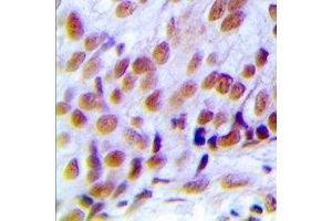 Immunohistochemical analysis of hNRNP C (pS260) staining in human breast cancer formalin fixed paraffin embedded tissue section.