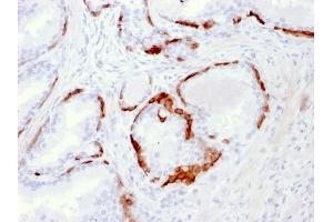 Formalin-fixed, paraffin-embedded human Prostate Carcinoma stained with Cytokeratin 14 Mouse Monoclonal Antibody (LL002). (KRT14 anticorps  (C-Term))