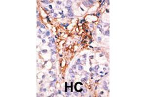 Formalin-fixed and paraffin-embedded human hepatocellular carcinoma tissue reacted with the APOBEC3G polyclonal antibody  , which was peroxidase-conjugated to the secondary antibody, followed by AEC staining. (APOBEC3G anticorps  (Internal Region))