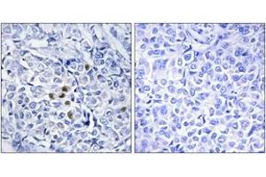 Immunohistochemistry analysis of paraffin-embedded human breast carcinoma, using PLK1 (Phospho-Thr210) Antibody.