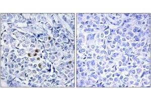 Immunohistochemistry analysis of paraffin-embedded human breast carcinoma, using PLK1 (Phospho-Thr210) Antibody. (PLK1 anticorps  (pThr210))