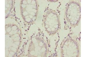 Immunohistochemistry of paraffin-embedded human colon cancer using ABIN7143865 at dilution of 1:100