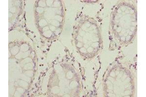 Immunohistochemistry of paraffin-embedded human colon cancer using ABIN7143865 at dilution of 1:100 (ENO1 anticorps  (AA 2-428))