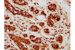 IHC image of ABIN7166319 diluted at 1:245 and staining in paraffin-embedded human breast cancer performed on a Leica BondTM system.