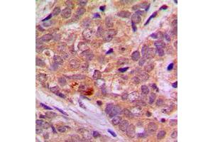Immunohistochemical analysis of LKB1 staining in human breast cancer formalin fixed paraffin embedded tissue section. (LKB1 anticorps  (C-Term))