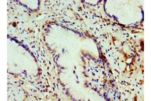 Immunohistochemistry of paraffin-embedded human cervical cancer using ABIN7148465 at dilution of 1:100