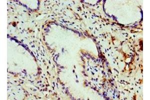 Immunohistochemistry of paraffin-embedded human cervical cancer using ABIN7148465 at dilution of 1:100 (COG7 anticorps  (AA 511-770))