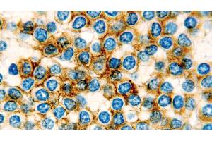 Human hairy cell leukemia: immunohistochemical staining for CD11c.