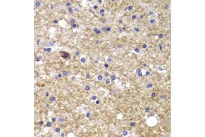 Immunohistochemistry of paraffin-embedded human brain cancer using CDK6 antibody. (CDK6 anticorps)