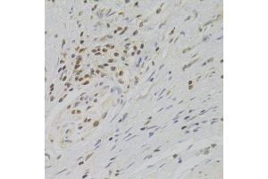 Immunohistochemistry of paraffin-embedded human gastric cancer using TAF1C Antibody. (TAF1C anticorps  (AA 70-320))