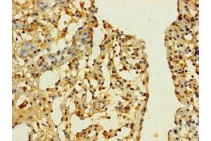 Immunohistochemistry of paraffin-embedded human bladder cancer using ABIN7170195 at dilution of 1:100