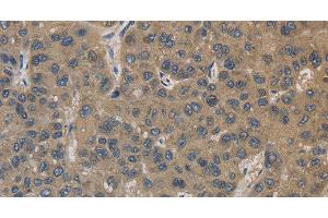 Immunohistochemistry of paraffin-embedded Human liver cancer using EMC8 Polyclonal Antibody at dilution of 1:30 (COX4NB anticorps)