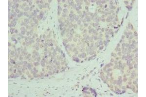 Immunohistochemistry of paraffin-embedded human gastric cancer using ABIN7142845 at dilution of 1:100 (RPL9 anticorps  (AA 1-192))