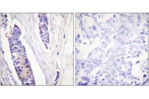 Immunohistochemistry analysis of paraffin-embedded human breast carcinoma tissue, using Tubulin beta Antibody. (TUBB anticorps  (AA 401-450))