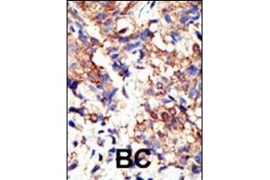 Formalin-fixed and paraffin-embedded human cancer tissue reacted with the primary antibody, which was peroxidase-conjugated to the secondary antibody, followed by DAB staining. (Ubiquilin 1 anticorps  (N-Term))