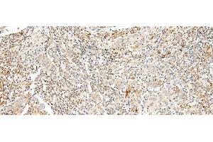 Immunohistochemistry of paraffin-embedded Human cervical cancer tissue using TAAR2 Polyclonal Antibody at dilution of 1:40(x200) (GPR58 anticorps)