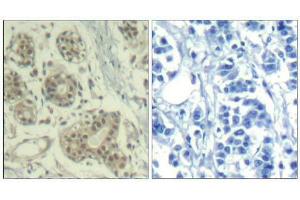 Immunohistochemical analysis of paraffin-embedded human breast carcinoma tissue using MDM2 (phospho-Ser166) Antibody (E011550). (MDM2 anticorps  (pSer166))