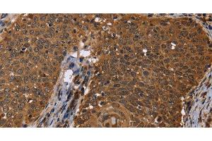 Immunohistochemistry of paraffin-embedded Human cervical cancer using DCP1A Polyclonal Antibody at dilution of 1:50 (DCP1A anticorps)