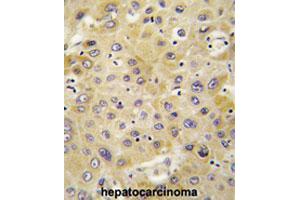 Formalin-fixed and paraffin-embedded human hepatocarcinomareacted with PPBP polyclonal antibody , which was peroxidase-conjugated to the secondary antibody, followed by AEC staining. (CXCL7 anticorps  (AA 99-128))