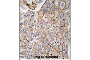 Formalin-fixed and paraffin-embedded human lung carcinoma tissue reacted with CLIC1 antibody, which was peroxidase-conjugated to the secondary antibody, followed by DAB staining. (CLIC1 anticorps)