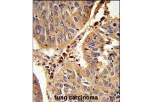 Formalin-fixed and paraffin-embedded human lung carcinoma reacted with PEX16 Antibody , which was peroxidase-conjugated to the secondary antibody, followed by DAB staining. (PEX16 anticorps  (AA 247-275))