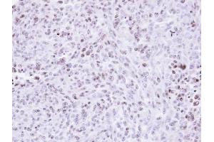 IHC-P Image Immunohistochemical analysis of paraffin-embedded H3347 xenograft , using ZNF707, antibody at 1:500 dilution. (ZNF707 anticorps)