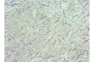 Immunohistochemistry of paraffin-embedded human colon cancer using ABIN7151313 at dilution of 1:100