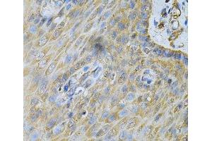 Immunohistochemistry of paraffin-embedded Human esophagus using PDGFB Polyclonal Antibody at dilution of 1:100 (40x lens). (PDGFB anticorps)