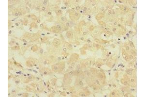 Immunohistochemistry of paraffin-embedded human gastric cancer using ABIN7151805 at dilution of 1:100 (TMPRSS15 anticorps  (AA 40-300))