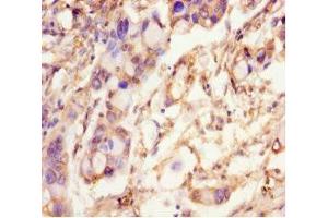 Immunohistochemistry of paraffin-embedded human pancreatic cancer using ABIN7168723 at dilution of 1:100 (SCAMP2 anticorps  (AA 1-153))
