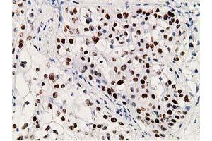 Immunohistochemistry (IHC) image for anti-Tumor Protein P53 (TP53) antibody (ABIN1499968) (p53 anticorps)