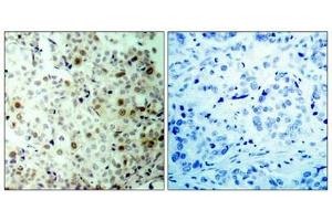 Immunohistochemical analysis of paraffin-embedded human breast carcinoma tissue using CDK2(Phospho-Thr160) Antibody (left) or the same antibody preincubated with blocking peptide(right).