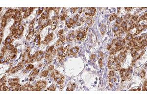 ABIN6278064 at 1/100 staining Human liver cancer tissue by IHC-P.