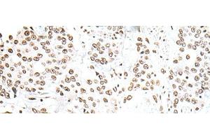 Immunohistochemistry of paraffin-embedded Human prost ate cancer tissue using SNRPA Polyclonal Antibody at dilution of 1:30(x200) (SNRPA1 anticorps)