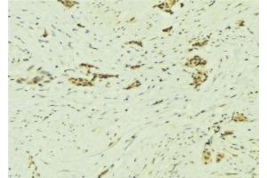 ABIN6277335 at 1/100 staining Human breast cancer tissue by IHC-P. (NAP1L1 anticorps  (C-Term))